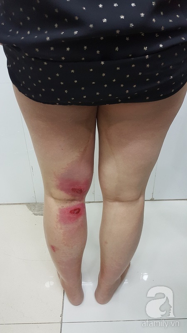 kiến ba khoang đốt mẹ bầu