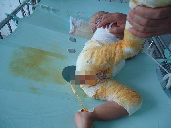 bé 21 tháng bị bỏng