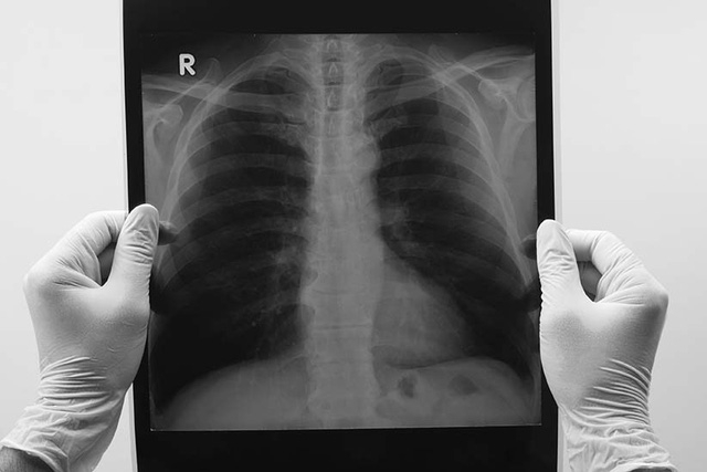 Hút thuốc lá không phải là con đường duy nhất dẫn đến ung thư phổi