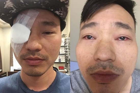 Cựu thành viên AC&M sợ bị mù vì rách võng mạc vô cùng nghiêm trọng