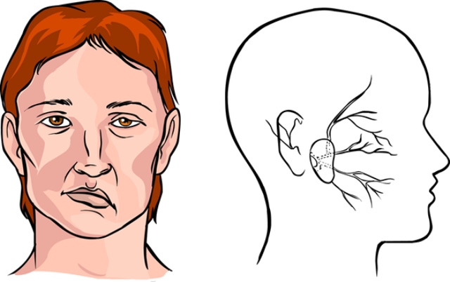  Vị trí dây thần kinh số 7. Ảnh minh họa. 