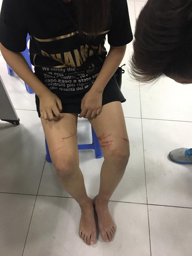Hà Nội: Nghi vấn cô gái trẻ bị kẻ “biến thái” quấy rối, dùng dao lam rạch nhiều vết vào đùi? - Ảnh 1.