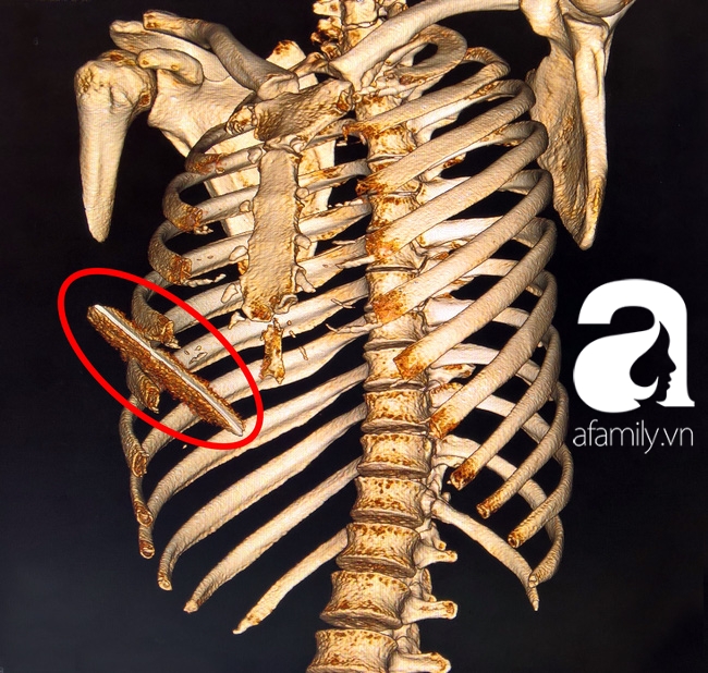 Thanh niên bị lưỡi dao 10 cm đâm lút ngực, thủng gan vẫn may mắn thoát chết - Ảnh 1.