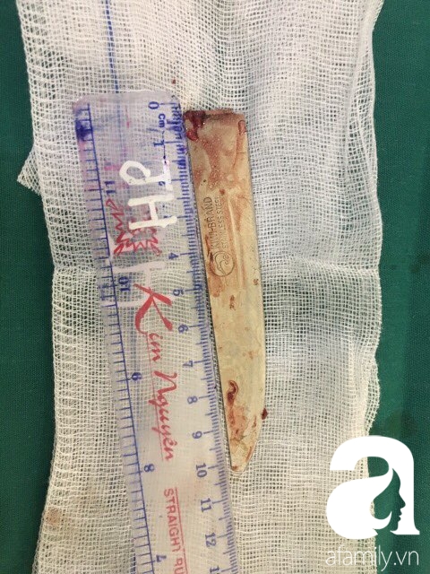 Thanh niên bị lưỡi dao 10 cm đâm lút ngực, thủng gan vẫn may mắn thoát chết - Ảnh 2.