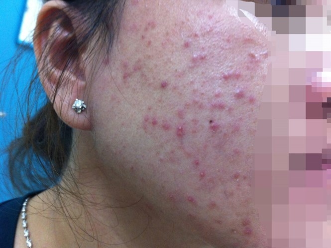 Một trường hợp dị ứng do dùng kem trắng da cấp tốc /// Ảnh: Nguyên Mi