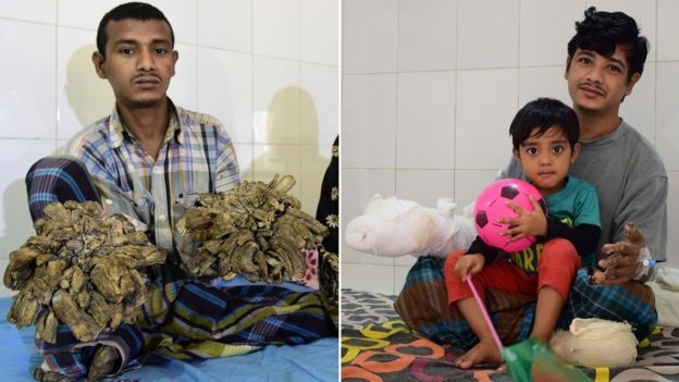 Co be 10 tuoi bi chung 'cay moc tren nguoi' tai Bangladesh hinh anh 2