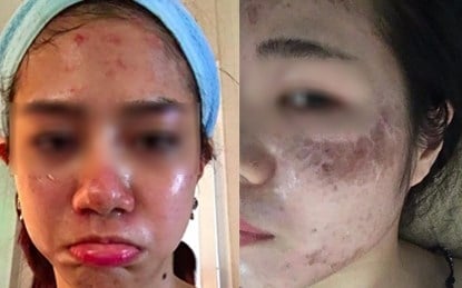 Lăn kim làm đẹp da: Hại thân, rước bệnh, dễ nhiễm … HIV ảnh 1