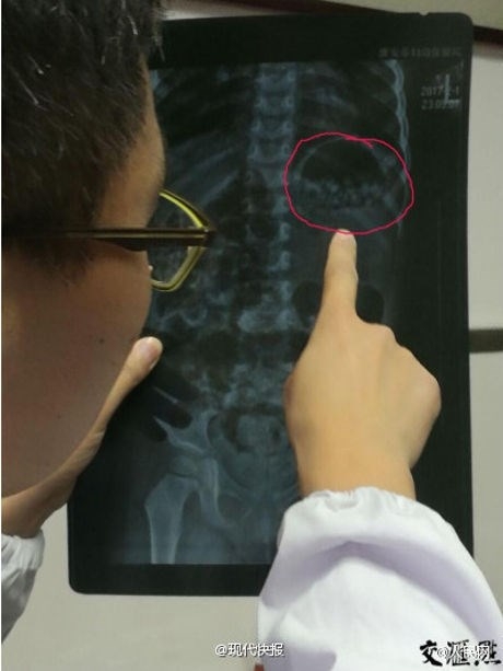 Bé gái ăn gần 300 hạt nhựa nở vì bố mẹ tưởng là kẹo ảnh 1