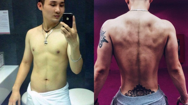 Bất chấp đau đớn, chàng trai Hà Nội chi 750 triệu đồng cắt bỏ xương sườn để có vòng eo bé xíu - Ảnh 1.