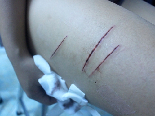 Các vết thương trên đùi luôn đau nhức khiến H. cảm thấy mệt mỏi Ảnh: Vũ Phượng