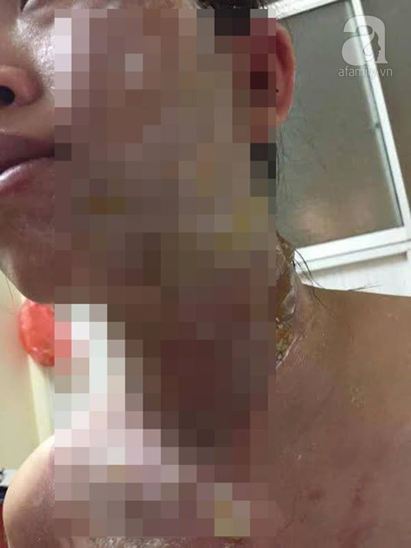  Tạt nguyên nồi nước sôi vào mặt bà bầu 5 tháng chỉ vì tranh chấp mặt bằng buôn bán - Ảnh 3.