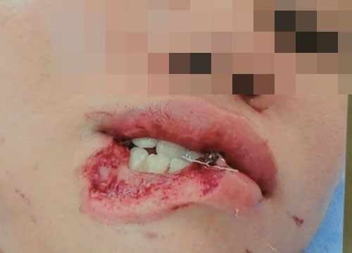 Nạn nhân bị tổn thương môi nghiêm trọng /// Quế Hà