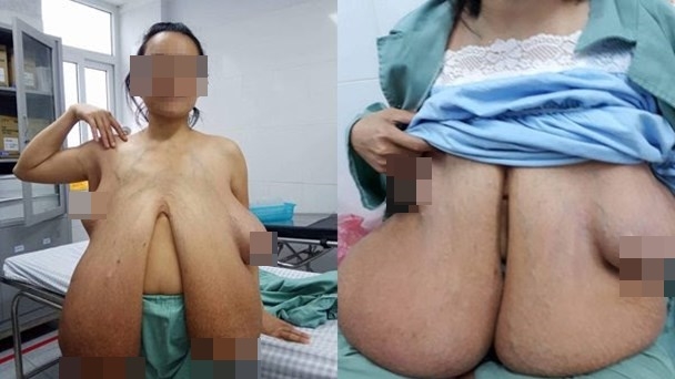 Người đàn bà có bộ ngực lớn bất thường ở VN: Tôi khổ lắm, chẳng làm được gì vì ngực nặng - Ảnh 1.