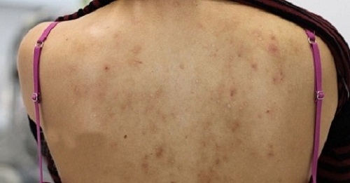 Vì sao nhiều người hay bị mụn trứng cá ở lưng và ngực? - 1