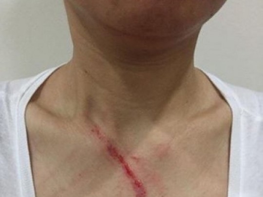 Chị V. cư dân chung cư Linh Đàm bị người hàng xóm đánh trầy xước chỉ vì nhắc nhở việc giữ gìn ý thức trong thang máy