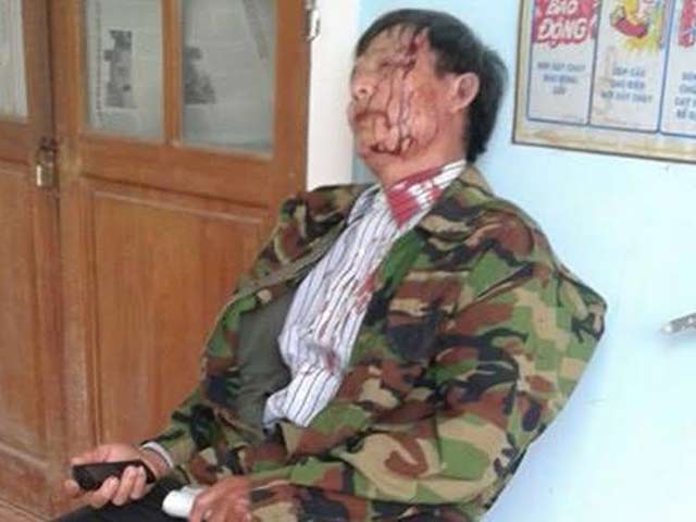 ghi am khi lam viec tai cong an xa, nguoi dan ong bi danh nhap vien? hinh anh 1