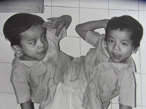nguoi-em-trong-cap-song-sinh-dinh-lien-viet-duc-tro-thanh-giao-su-tai-nhat-ban-1