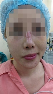 Bi thoi thit sau 2 ngay cay chi nang mui hinh anh 1