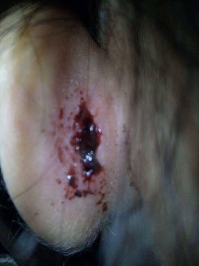 Cháu bé bị chảy máu tai chỉ vì quệt tay. (ảnh fb)