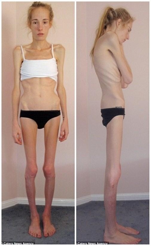 Cô gái gầy xiêu gầy đổ, suýt chết vì chứng biếng ăn năm xưa giờ ra sao? - Ảnh 2.