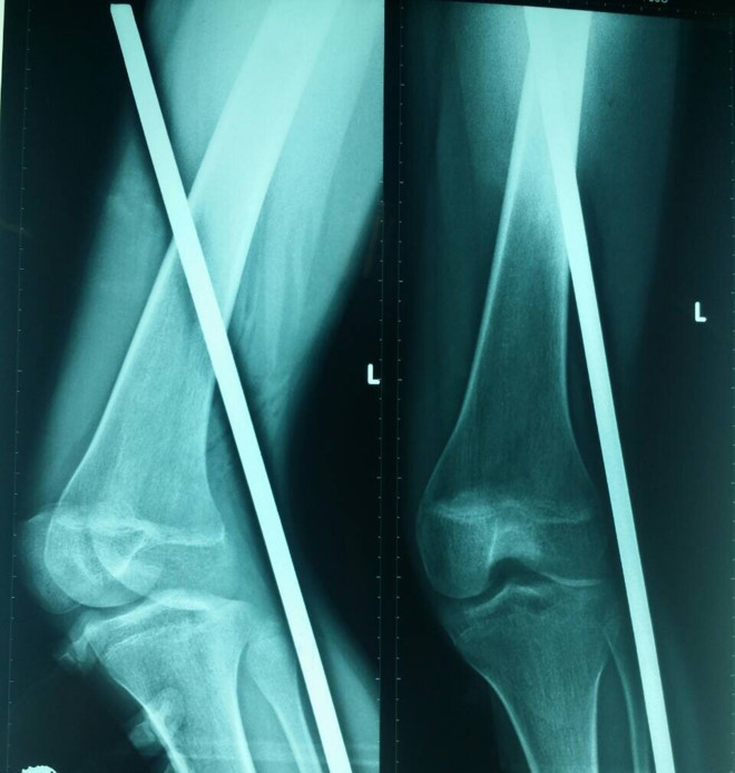 Tranh dong vat lieu ben duong, nu sinh bi que sat dam thau chan hinh anh 1