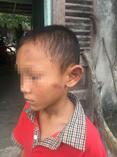 be trai 5 tuoi bi di ruot bao hanh da man hinh anh 1