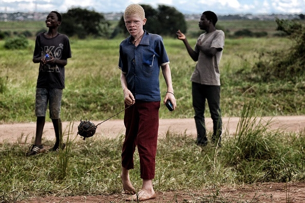 Noi so bi chat tay chan cua nguoi bach tang Malawi hinh anh 3