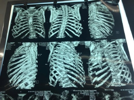 Đút rơm cho bò ăn, cụ bà bị gãy 8 xương sườn - ảnh 2