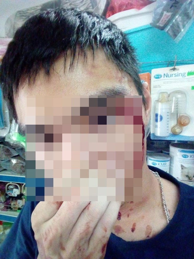 Anh M bị một vết thương ở dưới mắt, máu chảy nhiều, nam thanh niên vẫn đang trong tình trạng choáng váng, mệt mỏi và đau do vết thương.