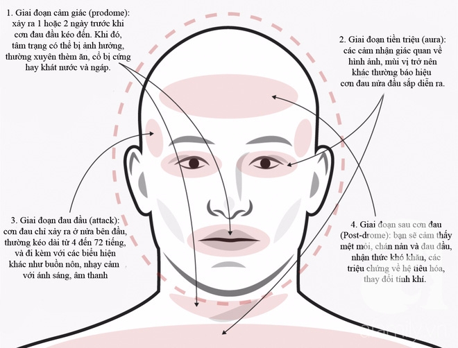 Không phải cơn đau đầu nào cũng giống nhau, phải biết phân biệt để điều trị đúng cách và kịp thời - Ảnh 3.