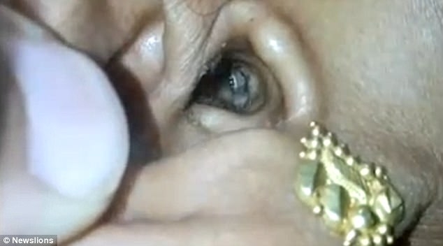 di kham vi dau dau, bac si phat hien nhen nam trong hinh anh 2