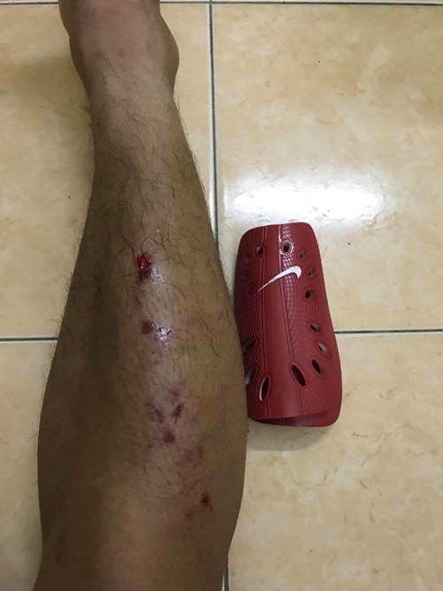 Nguyễn Anh Hùng: Nạn nhân của những pha 'chặt chém' ghê rợn nhất V-League - ảnh 1