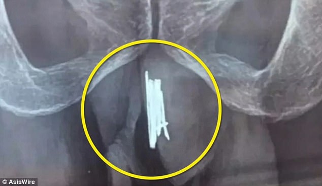  15 cây kim được tìm thấy trong của quý 