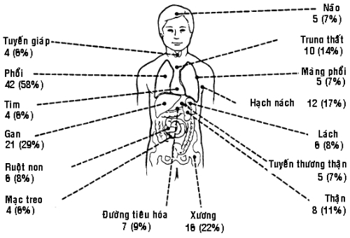 Các vị trí có thể di căn.
