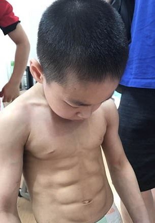 Cậu bé có tới 8 cơ bụng thay vì 6 múi
