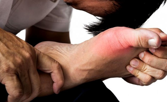 bệnh gout, gout, béo phì