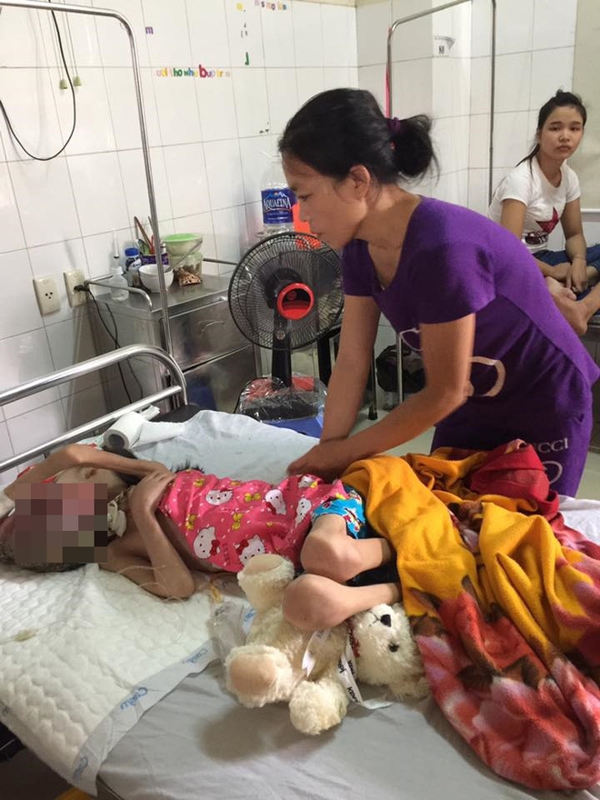  Chuỗi ngày đau đớn của bé gái 11 tuổi, mồ côi cha, bị khối u quái ác che kín mặt - Ảnh 1.
