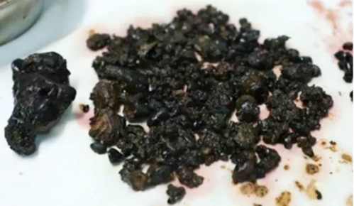 200-vien-soi-mat-trong-bung-nguoi-phu-nu-thuong-bo-bua-sang