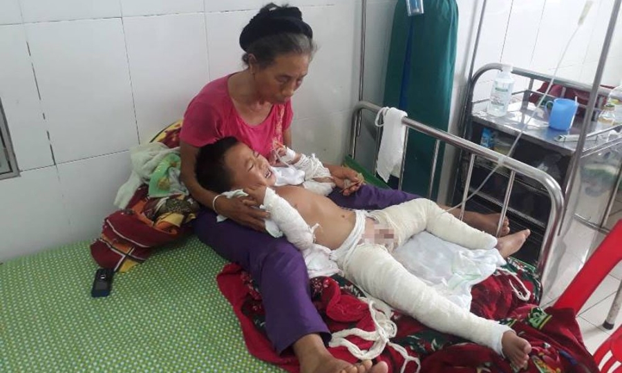 bỏng, bỏng xăng, Nghệ An