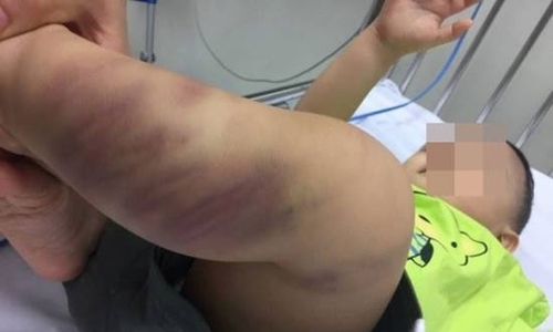 Bé trai một tuổi nghi bị bạo hành bơ vơ ở viện đang nguy kịch