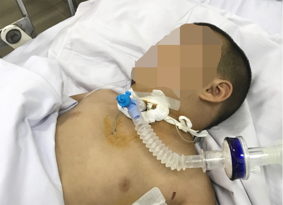 Cứu sống bé trai bị té lầu qua 3 lần phẫu thuật đầy cam go - ảnh 6