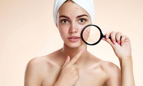 Chuyên gia bật mí bài thuốc Đông y cực đơn giản chữa dứt điểm mụn trứng cá, làm đẹp da - Ảnh 1.