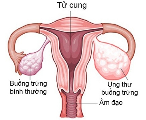 6-dau-hieu-la-cua-co-the-bao-hieu-ban-co-the-bi-ung-thu-buong-trung