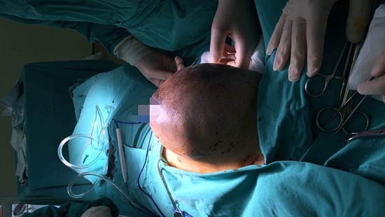Vừa sinh con, sản phụ phải cắt toàn bộ ngực phải vì khối u khủng