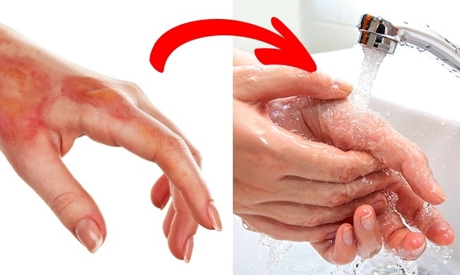 6 cách sơ cứu khi bị thương có thể gây tổn hại nghiêm trọng sức khoẻ của bạn - Ảnh 4.