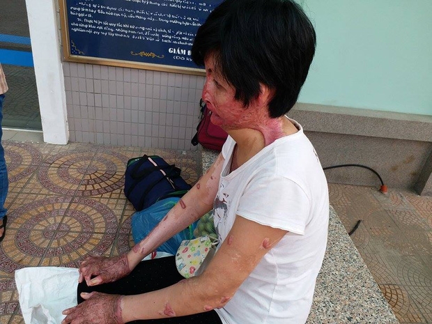 Gặp lại người phụ nữ từng bị chồng nhốt, tẩm xăng thiêu sống: Tôi không còn oán hận, chỉ mong có ngày đoàn tụ với con - Ảnh 1.