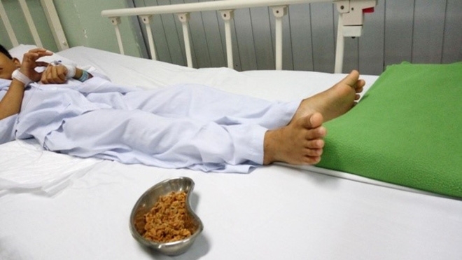 Hậu Giang: Con đau quặn bụng 4 ngày, mẹ tá hoả phát hiện hàng chục hạt sơ ri trong người bé trai 11 tuổi - Ảnh 1.