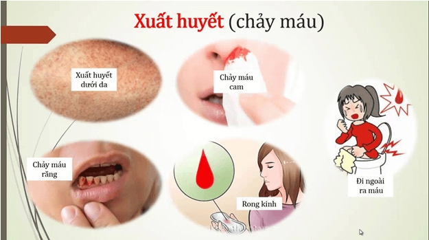 Sốt xuất huyết có lây qua đường tình dục không? - Ảnh 1.