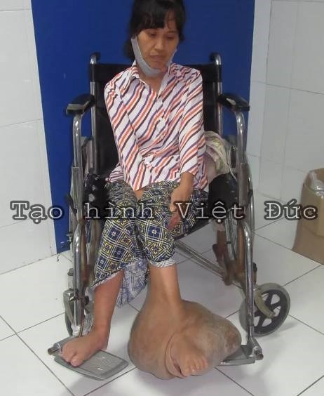 “Giải cứu” cho bệnh nhân mang khối u khổng lồ gần 40 năm - ảnh 1
