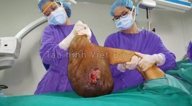 “Giải cứu” cho bệnh nhân mang khối u khổng lồ gần 40 năm - ảnh 2